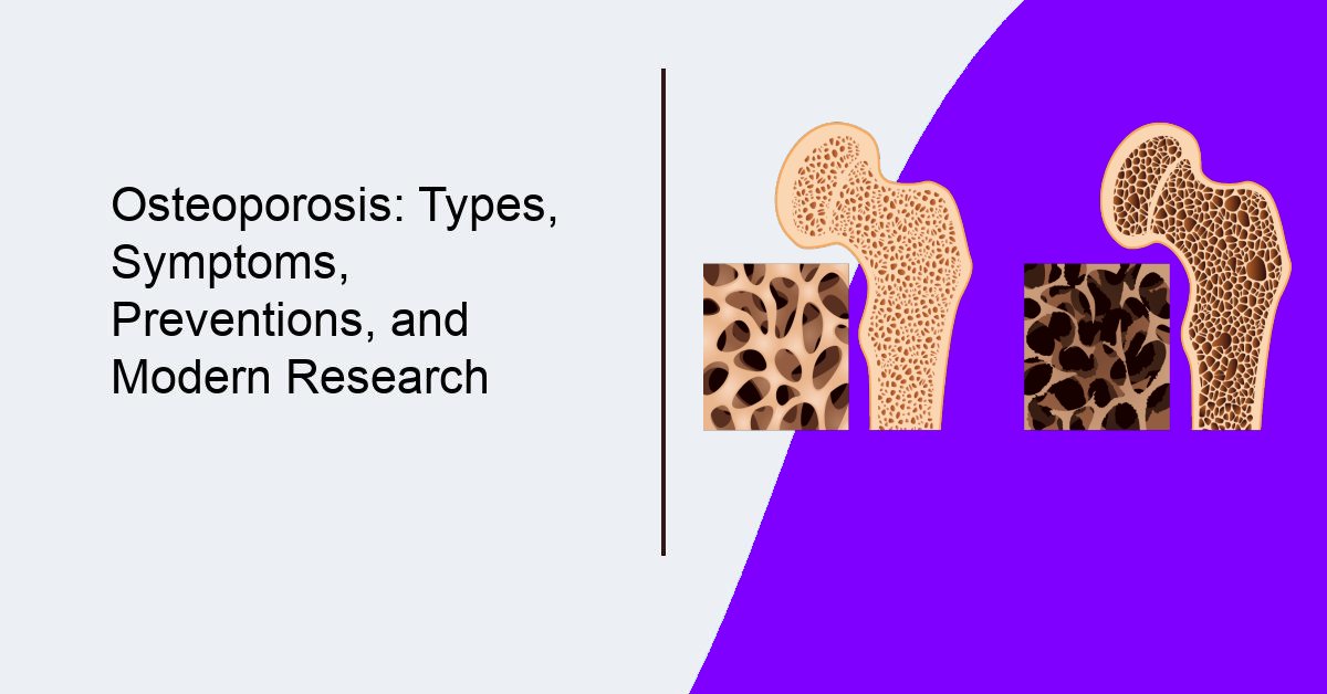 Osteoporosis Types, Symptoms, Preventions, and Modern Research